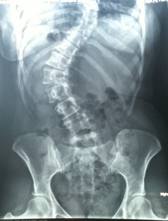 My twisted spine